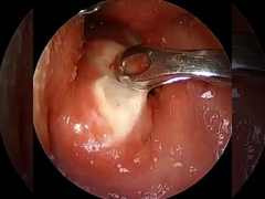 Mevcut ≤1.5mA Artroskopi RF Plasma Çubuk Cerrahi Ekipmanlar Omuz Kalça Diz